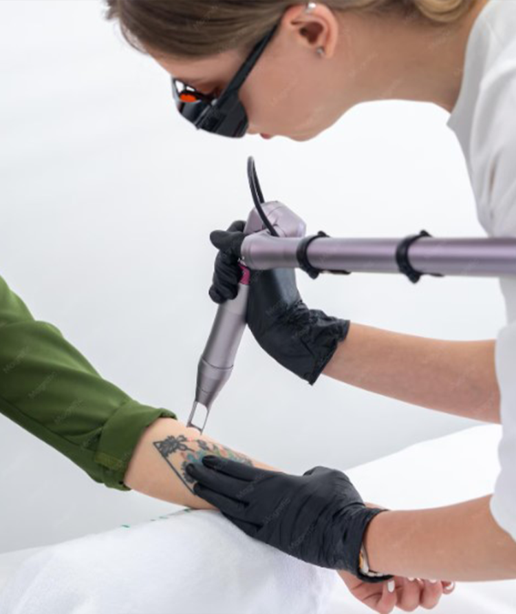 remmovel tattoo remmovel tattoo