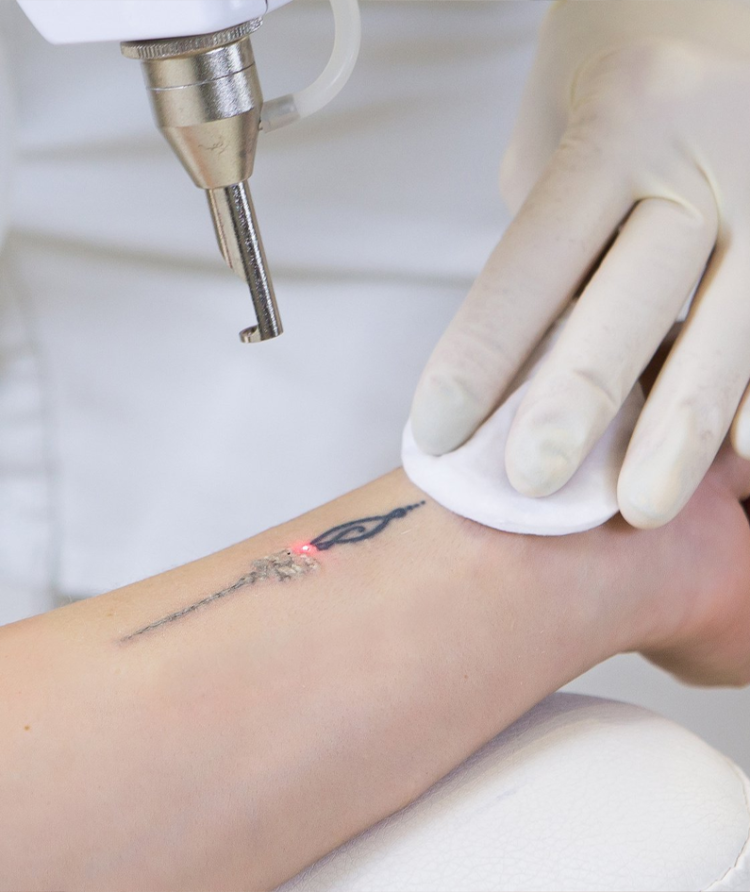 removbe tattoo removbe tattoo